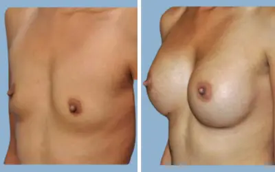 Before and After